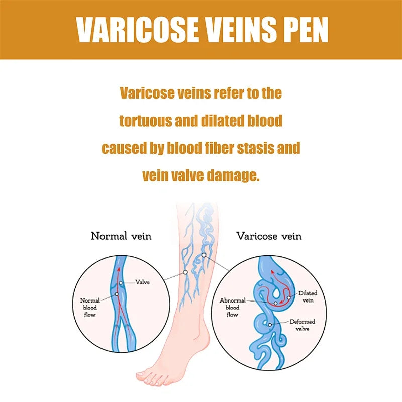Laser Therapy Pen for Varicose Veins | Blue Light Treatment Device for Pain Relief & Circulation Improvement