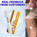 Laser Therapy Pen for Varicose Veins | Blue Light Treatment Device for Pain Relief & Circulation Improvement