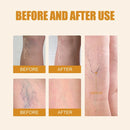 Laser Therapy Pen for Varicose Veins | Blue Light Treatment Device for Pain Relief & Circulation Improvement